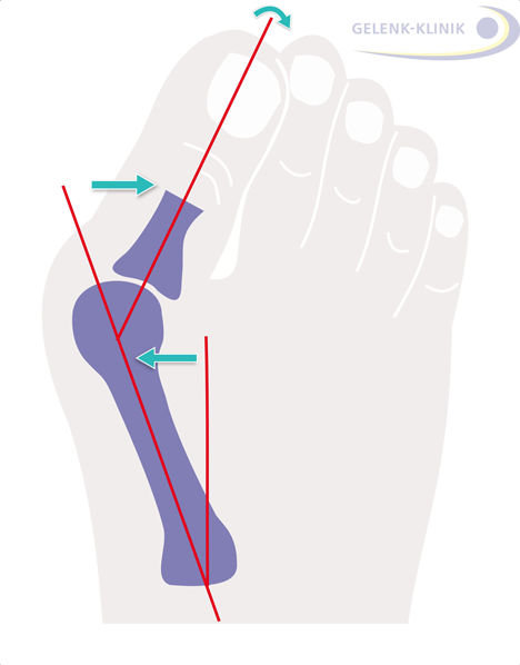 الشكل 1: الهالوكس فالجوس أو تورم إبهام القدم هو عبارة عن (اصابع قدم معوجة) هي وضعية خاطئة لابهام القدم في مفصل اصبع القدم الكبير: السمة هي انعواج إبهام القدم الى الخارج. بسبب التصادم المتزايد مع الحذاء ينتج عن طريق الاحتكاك التهاب الجراب (بورصة) في المفصل المشطي السلامي، وغالبا ما يتبعه تورم آخر.© Gelenk-Klinik.de