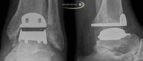 الشكل ١٨: التهاب مفصل الكاحل كما يتم رؤيته في صورة أشعة إكس.
