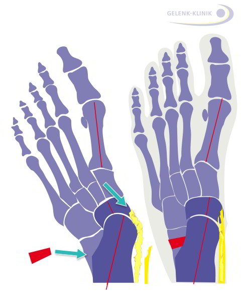 Sketch of flat valgus foot with weakened posterior tibial tendon