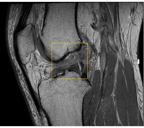 صورة لتمزق رباط صليبي يظهر بأشعة الرنين المغناطيسي (MRI)