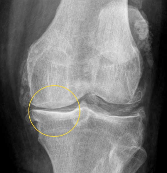 Knee arthrosis