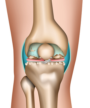 هناك العديد من الأسباب لحالة تآكل مفصل الركبة المؤلم.