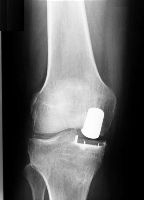 Partial knee prosthesis