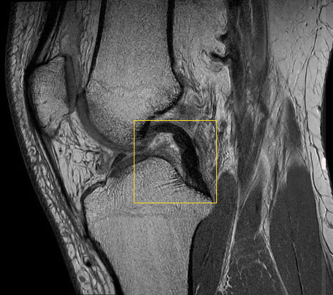 صورة لأشعة رنين مغناطيسي (MRI) لمفصل ركبة برباط صليبي خلفي سليم