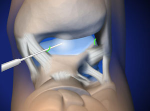 إجراء تنظير مفصل الكاحل من قبل جراح العظام الخبير بالقدم